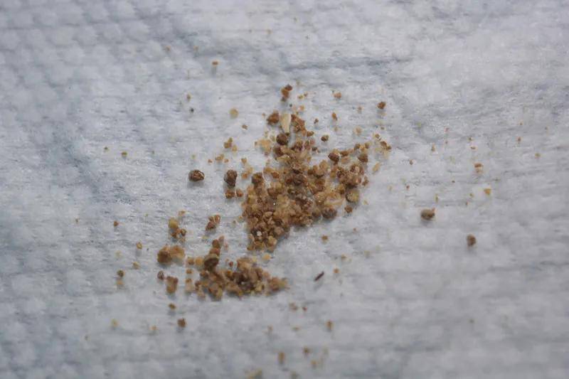 锦旗相送:深陷结石"恶梦"20载 长航外科轻松解梦_王师傅_碎石_手术