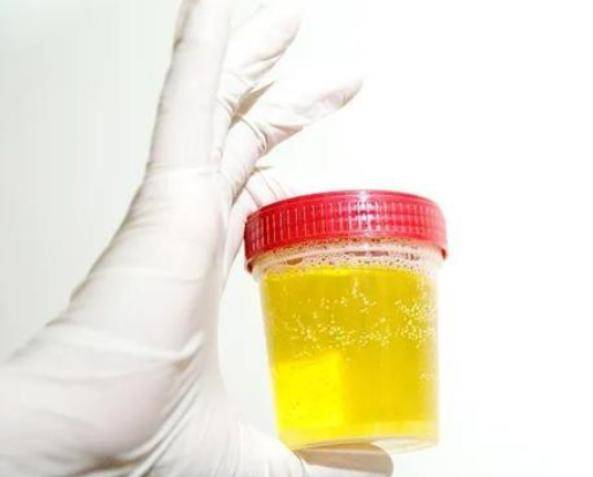 物质|手上若有这3个现象，可能是尿酸高了，若做好3件事，或能改善尿酸