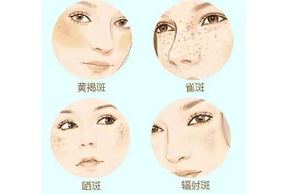 方法想要彻底下“斑”？别再踩雷了，真正有效的祛斑方法在这里...