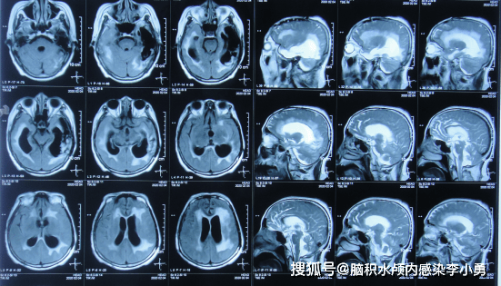 圖-3:2020年1月16日頭顱核磁第3家醫院治療近2個半月,期間兩次(2020年