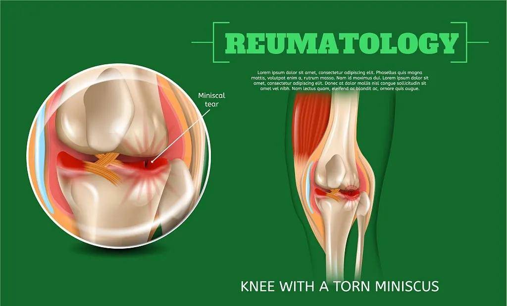 案例分享 临床试验证明 干细胞治疗半月板损伤更具有优势 膝关节 软骨 患者