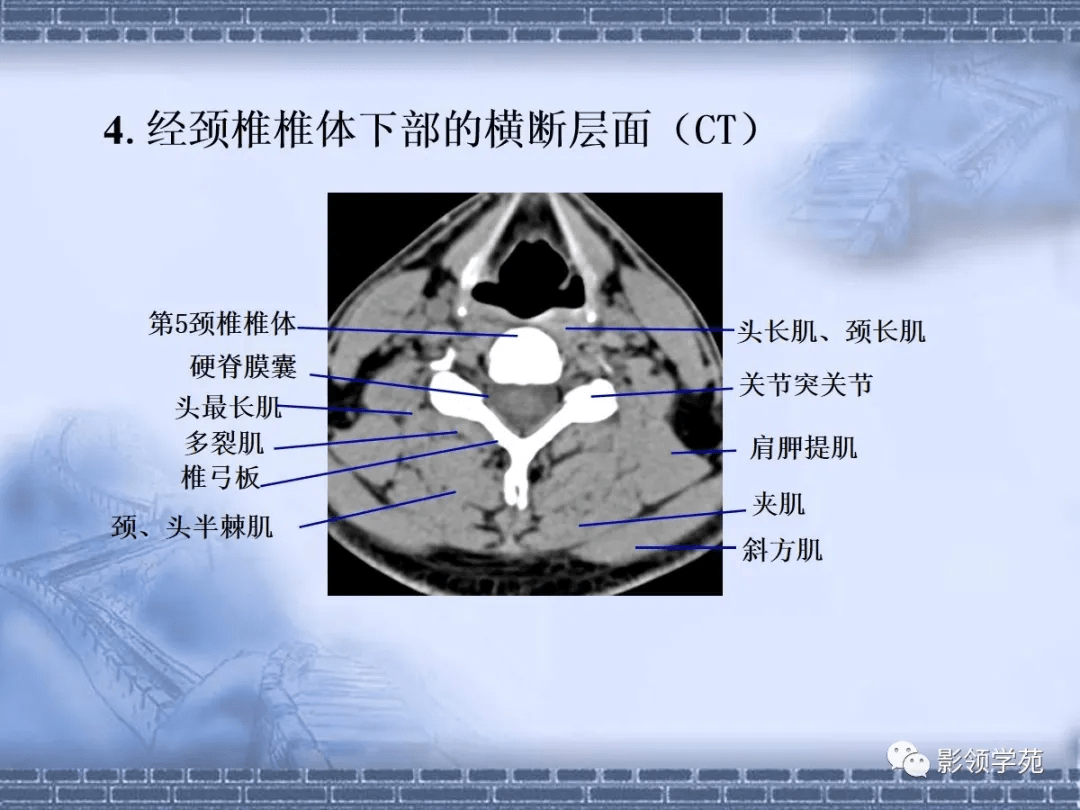 正常颈椎间盘ct图解图片