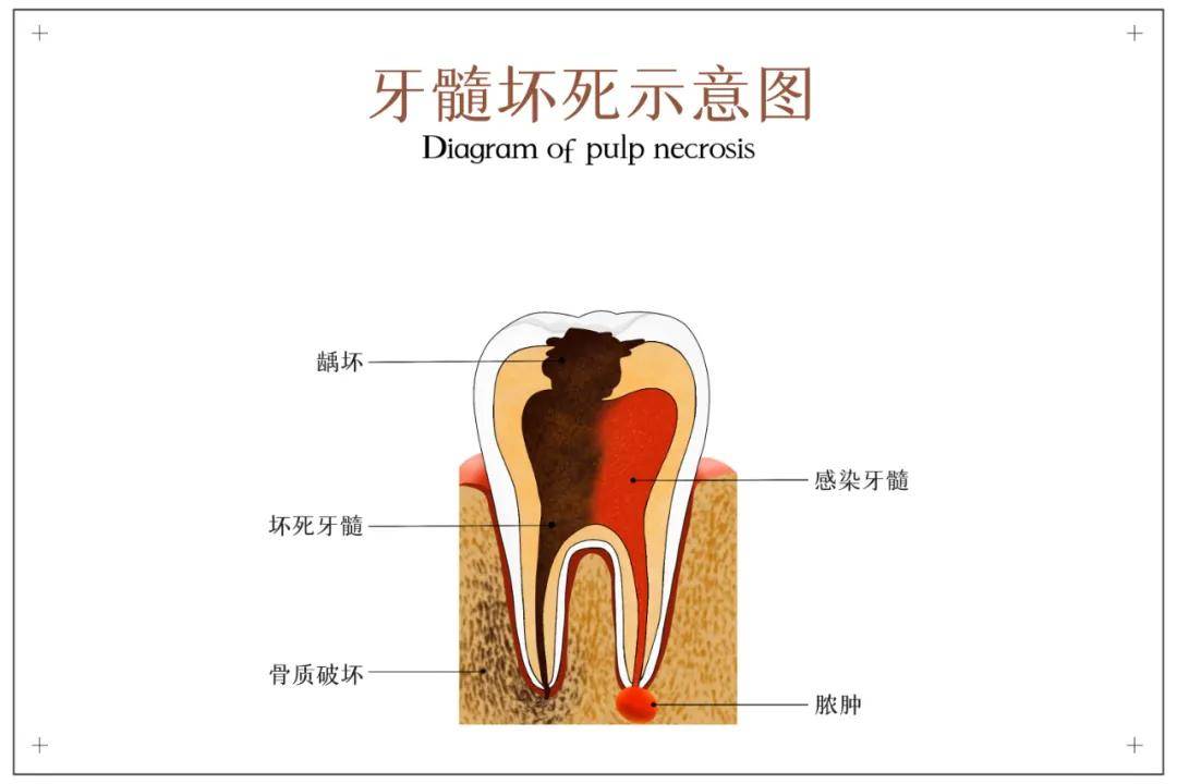 牙髓底穿示意图图片