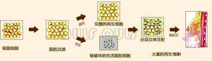 能量丑：脂肪填充2个月好难看？全脸脂肪填充后遗症让我好后悔~