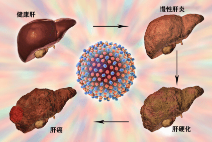 治疗|肝脏“天然解毒王”公布，每天吃两口，排出肝毒，肝硬化不攻自破