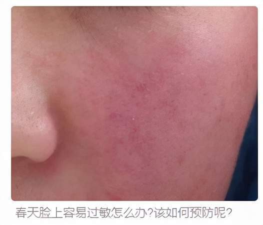 免疫力女明星都会过敏！肌肤免疫力可不是有钱就能买到