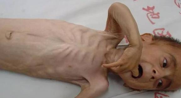 结局|这个指标可预示肾病的结局，可惜大部分肾友不认识它