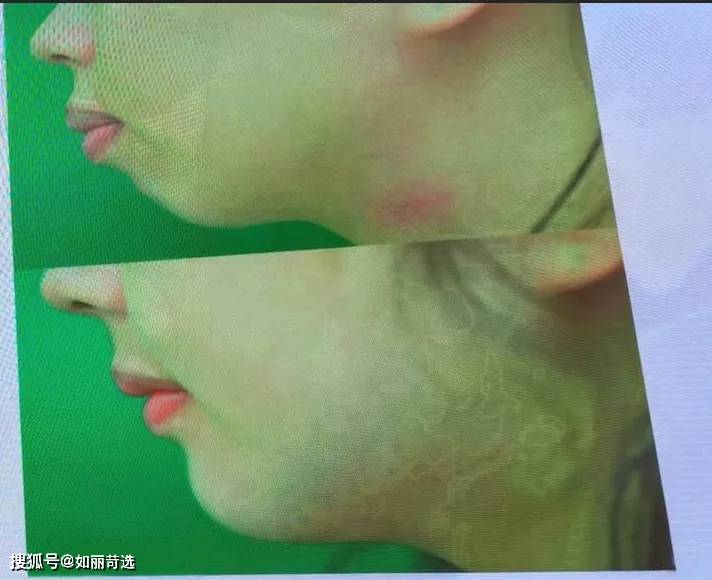 宋轶凸嘴无法修复的四种迹象，千万别中招