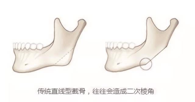 变化那些削骨“一刀切”的明星还好吗？有的已垮掉，小方脸成最后赢家