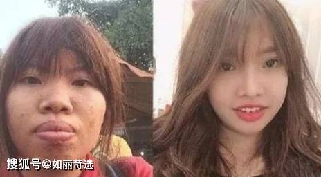 宋轶凸嘴无法修复的四种迹象，千万别中招