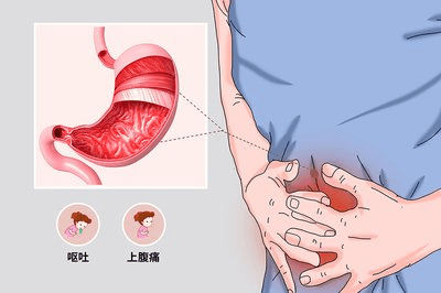 由于吸烟能减慢胃排空,应予戒烟,应尽量避免使用能延迟胃排空的药物
