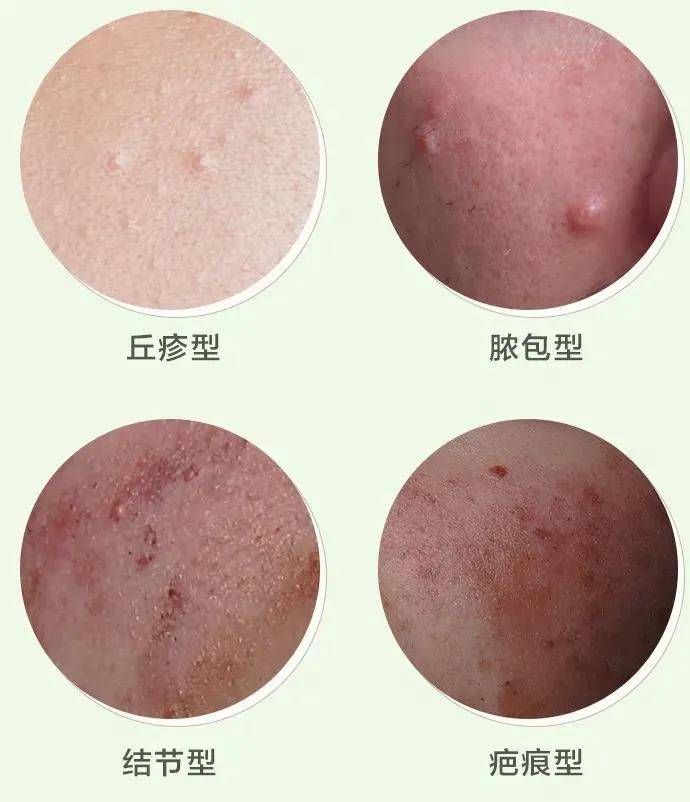 黑头1分钟教你认清，脸上各种小疙瘩并消灭它！