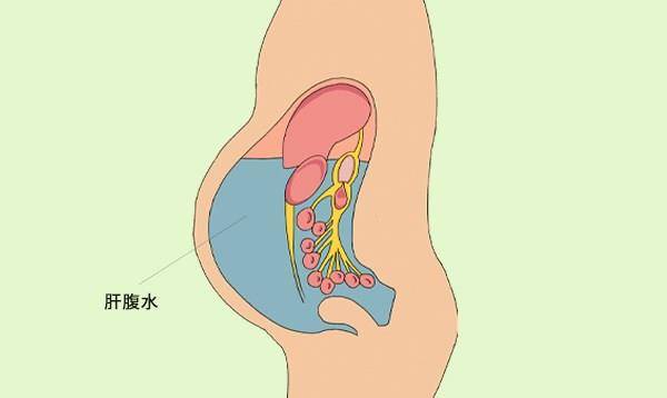 肝脏|肝腹水是种什么病？肝病科医生：日常遵循“四不”原则，延缓病情