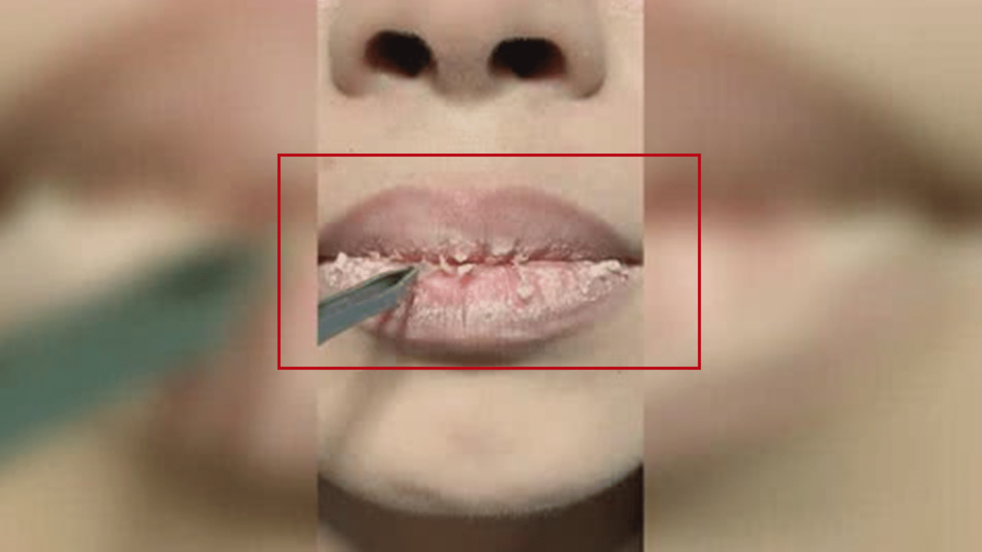 效果|宝宝嘴唇干裂起皮，母亲非常担忧？正确护理比喝水管用