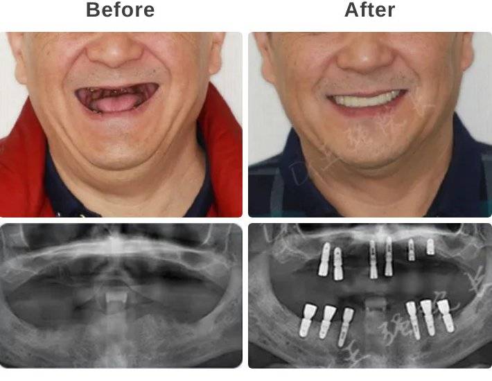 一口種植牙一輛特斯拉王強院長半口全口牙齒種植案例