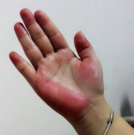 免疫力|肝脏有疾，双手先“知道”，如有3种“反常”，劝你早日养肝