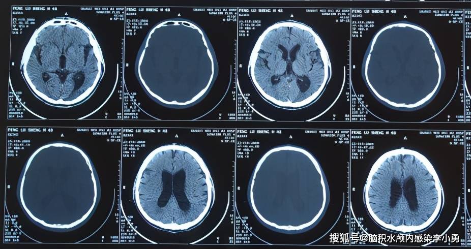 在山西省某三甲医院复查,头颅ct提示"梗阻性脑积水,侧脑室,三脑室增大