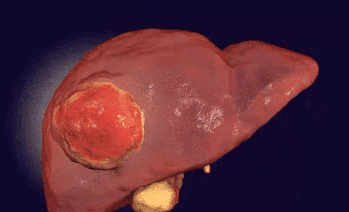 肝癌并非悄无声息无论男女如厕有3种反常或是癌细胞在扩散