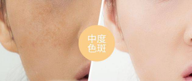 人群黛维依祛斑是真的_想要去掉脸上的斑,好用又少折腾的办法分享给你