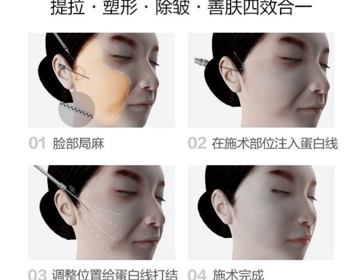 能量细解：线雕面部提升要多少钱？面部线雕价格一般大概多少算不贵？