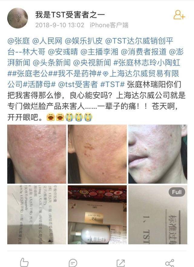 人脸明星光环下的TST受害者：有人脸脱皮六次，有人纱布捆手防抠脸