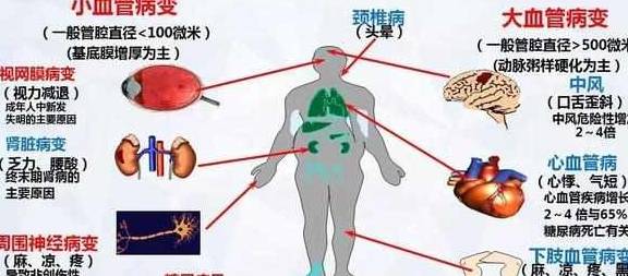 治疗|糖尿病不得并发症，血糖不能高也不能太低