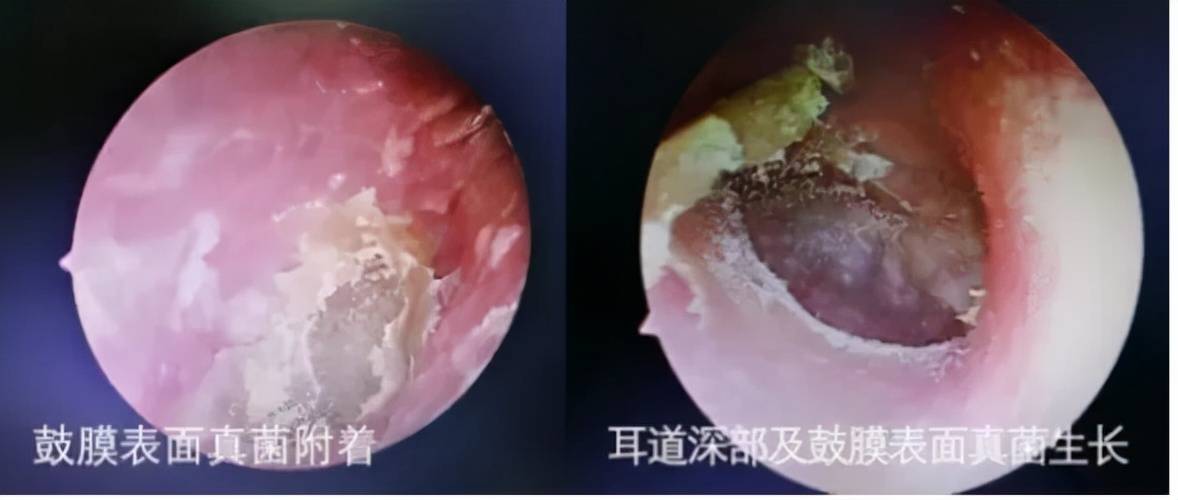 你还在给孩子掏耳屎吗快住手