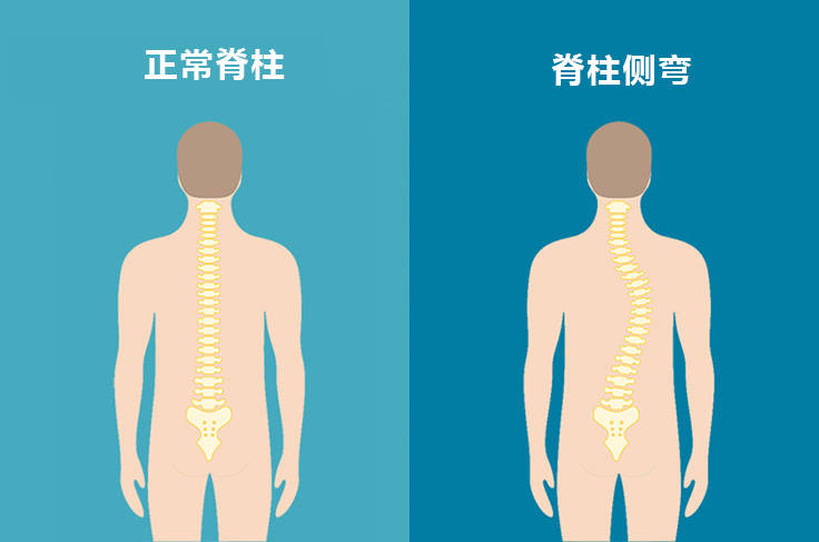 正常脊柱 vs