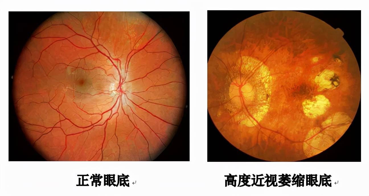 警惕高度近视还可能导致失明