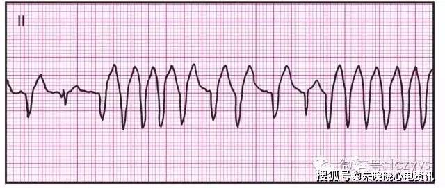 常見心電圖圖文參考_心室_房室_旁路