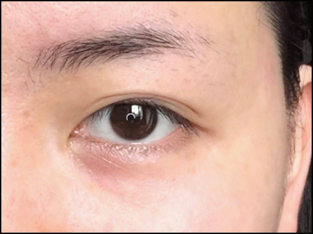 血管3种超实用遮黑眼圈大法，手残党一看就懂！
