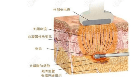什么黄金微雕和线雕有什么区别？法令纹做线雕效果怎么样？