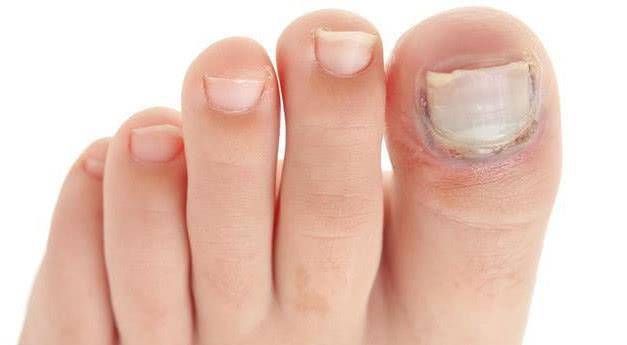 灰指甲怎么治疗 2e050be4a9854d83911b88e2fde44811.jpeg