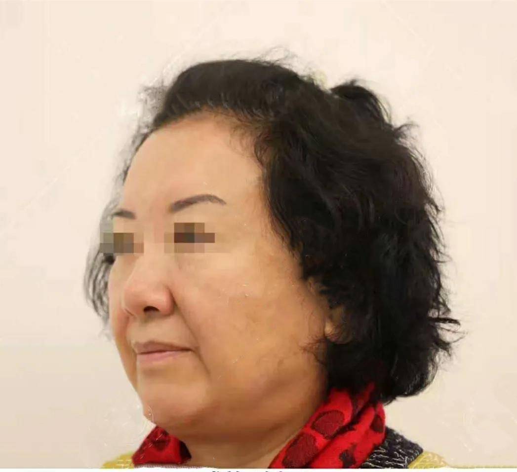 大姐60岁大姐面部提升真实经历：术后10天换脸实拍，为了美她也是拼了