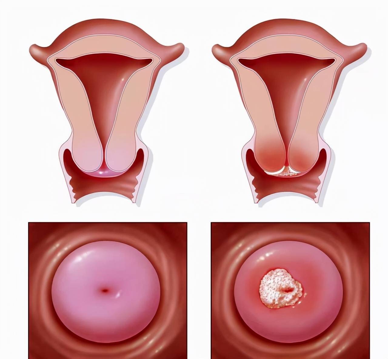 女性巴氏囊肿的图片图片
