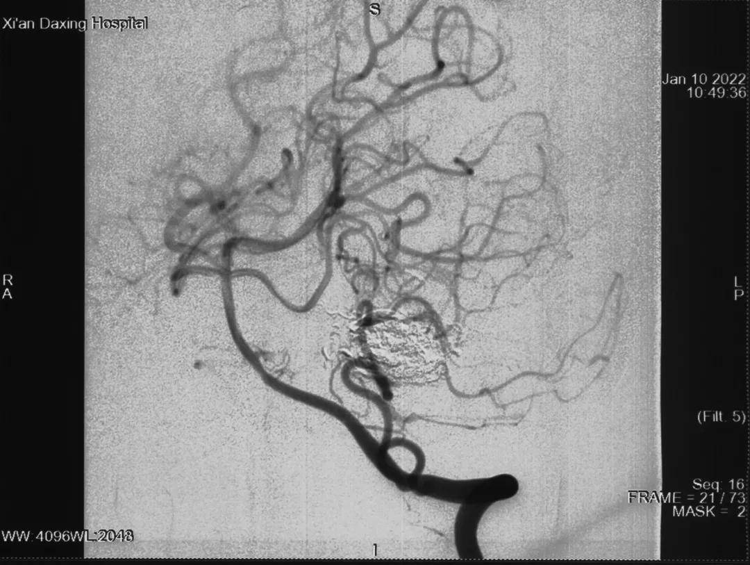 畸形|当11岁女孩巧遇这对“缠绵恋人” 看神经外科专家如何一招制胜