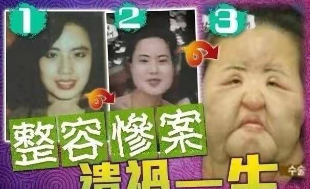 因为10位整容毁掉的女星：有人自己注射食用油，有人上瘾，有人丢了命