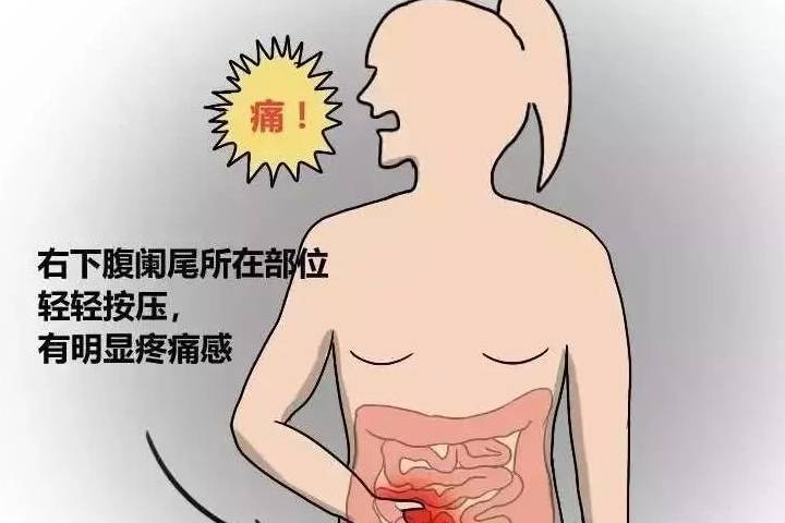 治疗|粪石是什么东西，为什么会跑到阑尾里面去，有生命危险吗？