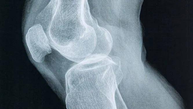 什么是滑膜炎积液 14722a264644414194394f06c80c3e78.jpeg