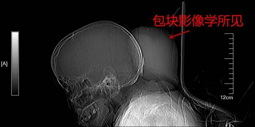 刘江峰|半生双“头”苦不堪言 今朝祛除一身轻松