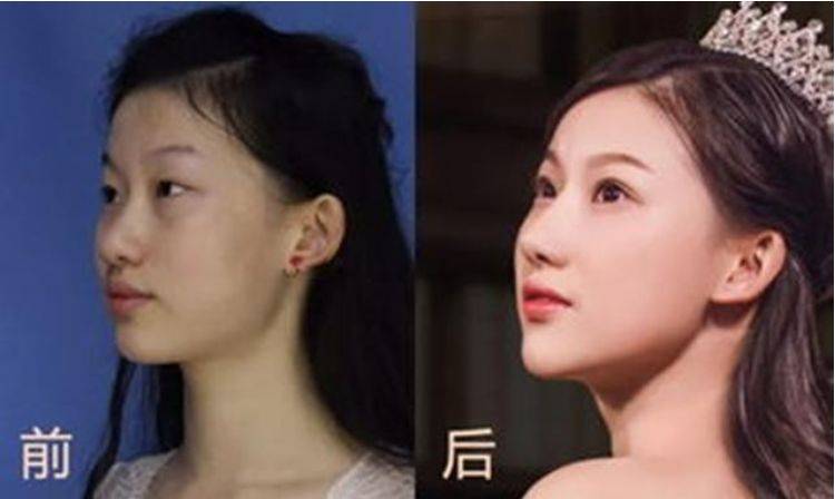 李奕霏19岁女孩花百万按照刘亦菲整容，梦想破灭后，她的现状如何