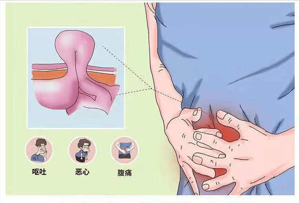 盐城德馨 疝气患者需要积极预防并发症_部位_腹部_切口