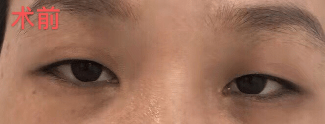 黎小姐女子称双眼皮手术后眼睛睁不开 医美机构:是你眼睛问题