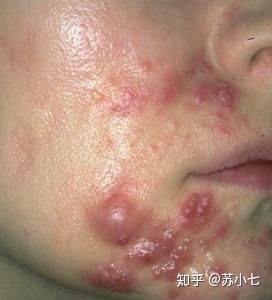 因为痘痘的诞生
