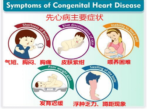 什么是室间隔缺损?