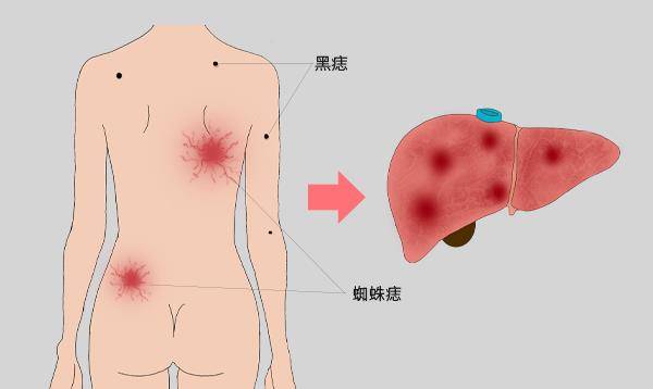 肝脏|身上出现异常皮肤痣，或许是肝硬化找上门，别拖，不然会很麻烦