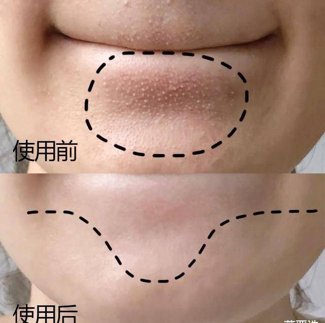 毛孔王源脸上痘痘越发严重，众人呼吁让他戒烟，美颜滤镜都救不了