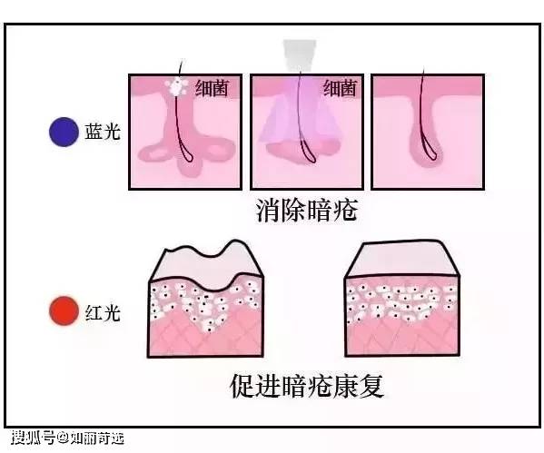 果酸女孩挤痘痘诱发败血症?祛痘千万不能做的那些事儿！纯干货祛痘指南分享!