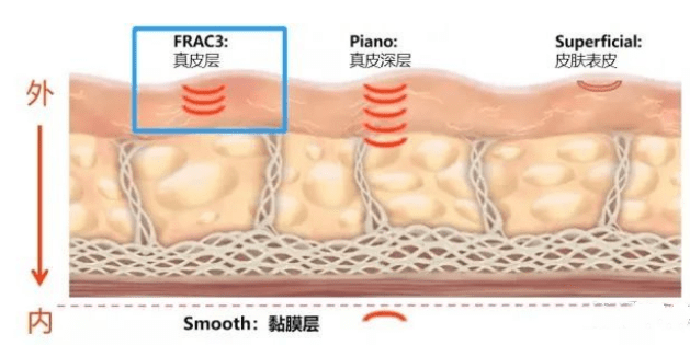 美容|Fotona4D美容 云南铜雀台杨才华讲解Fotona 4D Pro