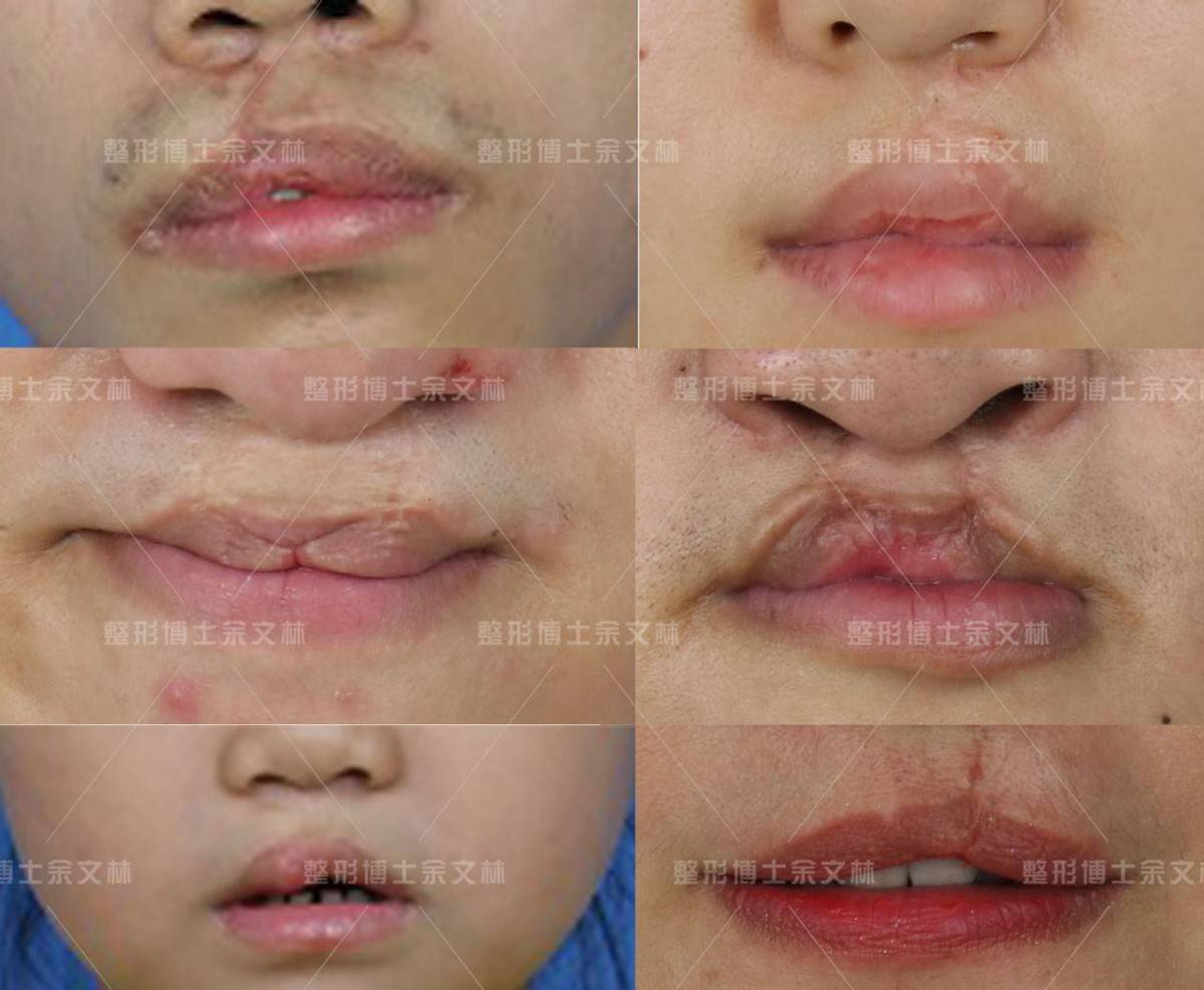 兔唇唇裂第二次修复手术多久可以见效